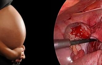 Апоплексия яичников и беременность: до, во время и после неё, каковы шансы и последствия