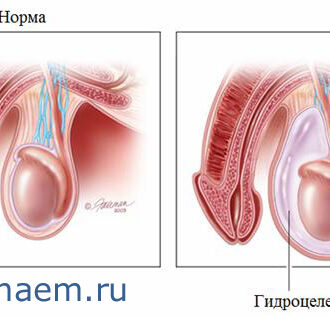 Водянка яичка может привести к бесплодию! | Проблемы мужского и женского бесплодия и методы их решения
