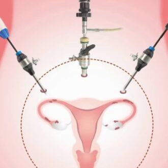 Что такое лапароскопическая операция и в чем ее преимущества?