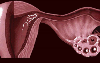Причины женского бесплодия — статья МЦРМ