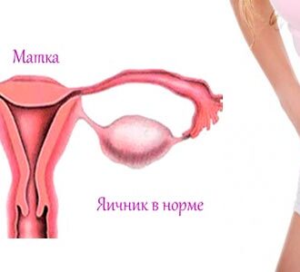 Киста яичника грозит бесплодием