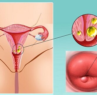 Киста шейки матки: чем она опасна, как лечить и нужно ли ее удалять — ГБУЗ МО Мытищинская районная женская консультация