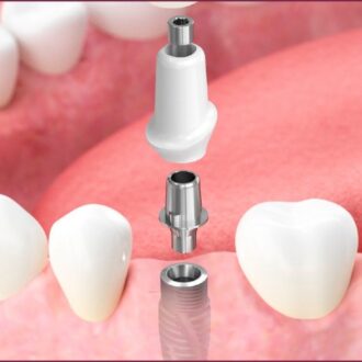 Выбор абатментов