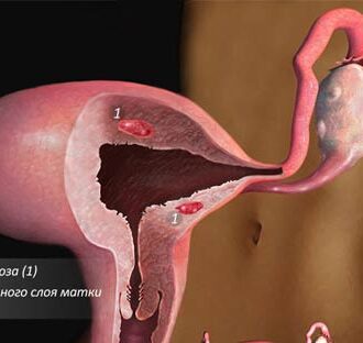 Аденомиоз матки: формы, степени, факторы и природа заболевания