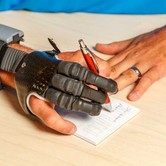 Что делать, когда нужен протез руки?