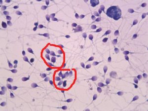 Агглютинация в спермограмме и способность к оплодотворению