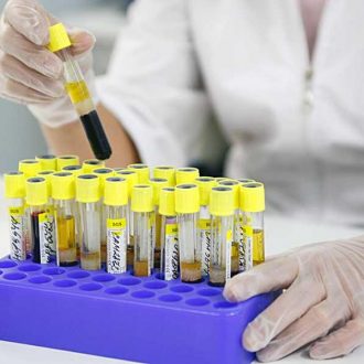 Если фибриноген в крови определяется выше нормы — что это значит?