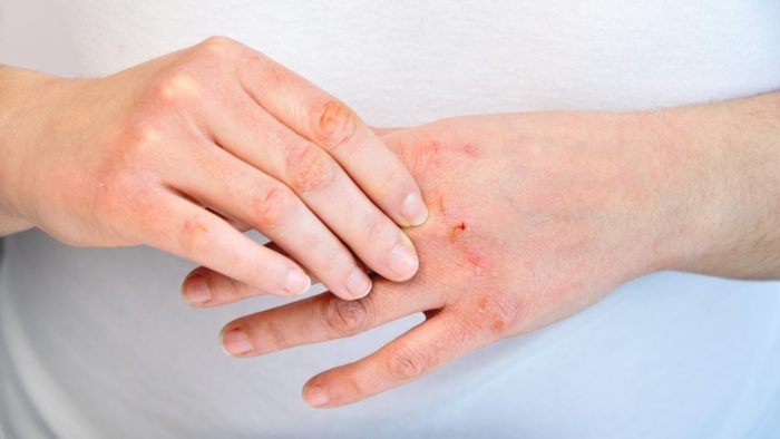 Советы по поддержанию здоровья при атопическом дерматите