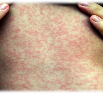 Осложнения кори