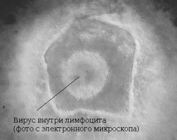 Эпштейн барр вирус и бесплодие