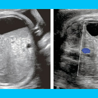 Беременность при кисте желтого тела: возможно ли это