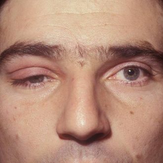 Миастения: симптомы, диагностика и лечение