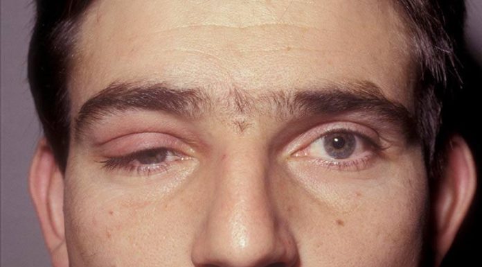 Миастения: симптомы, диагностика и лечение