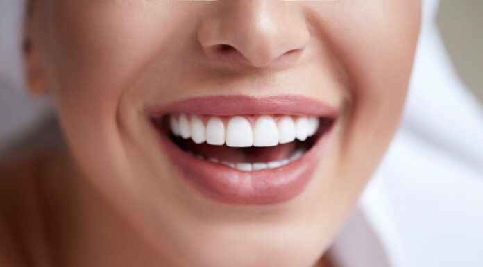 Виниры — какие выбрать и всем ли ими пользоваться?