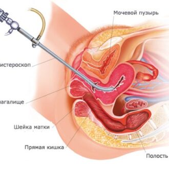 Гистероскопия при бесплодии: как проводится и что дает