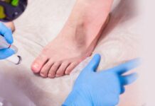 Як лікувати оніхомікоз