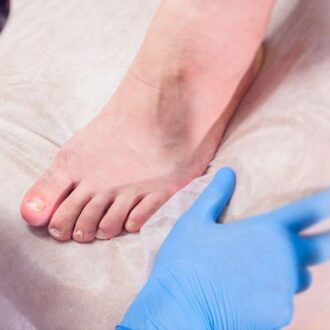 Як лікувати оніхомікоз