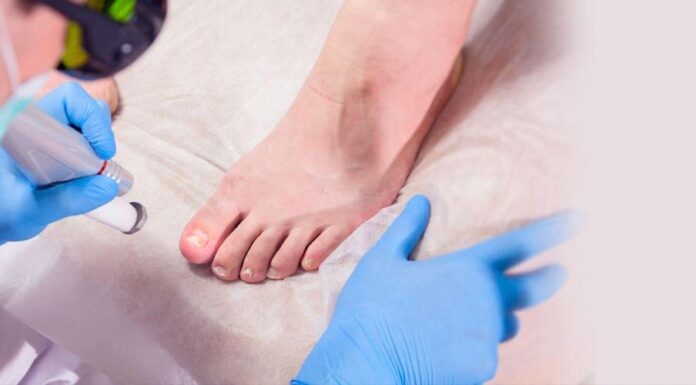 Як лікувати оніхомікоз