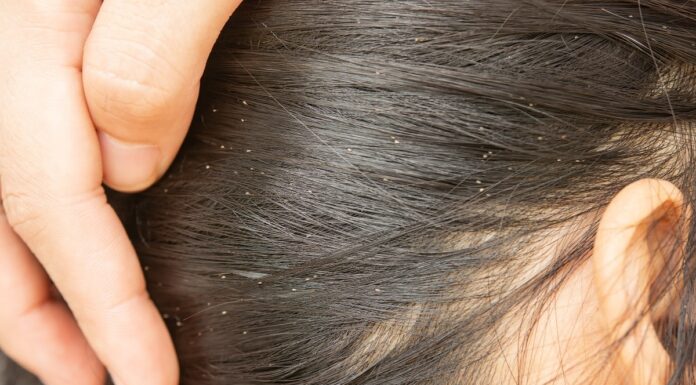 Все о головных вшах