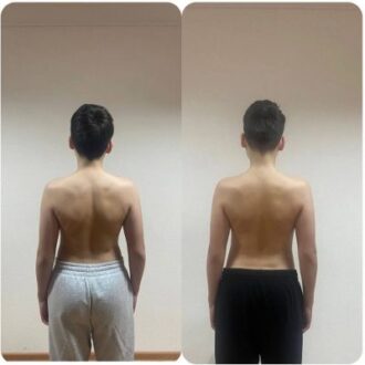 Лечение сколиоза у детей