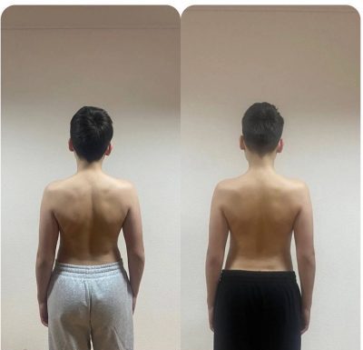 Лечение сколиоза у детей