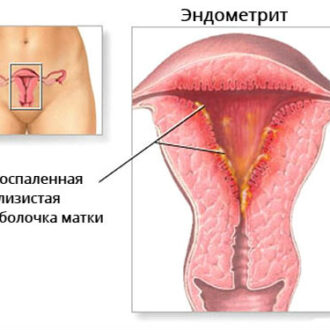 Эндометрит как причина бесплодия: когда это возможно
