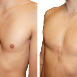 Воронкообразная деформация грудной клетки — чем страшна и лечится ли?