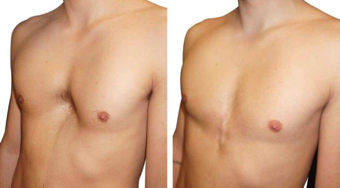 Воронкообразная деформация грудной клетки — чем страшна и лечится ли?