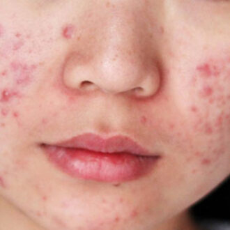 Угревая сыпь и бесплодие