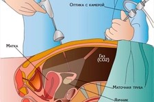 Как делают лапароскопию при непроходимости маточных труб