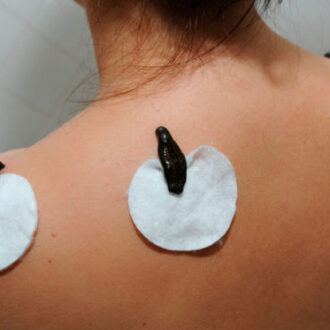 Гирудотерапия при бесплодии у мужчин и женщин