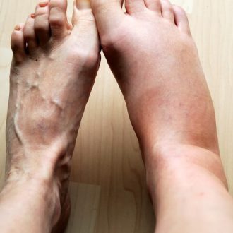 Отеки после родов или кесарева сечения