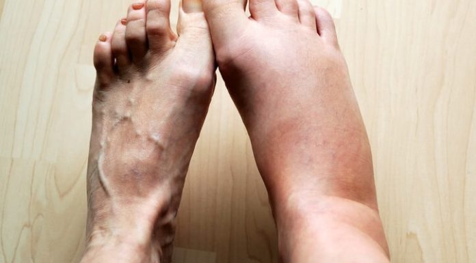 Отеки после родов или кесарева сечения