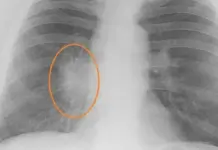 Затемнение в лёгких: что это такое и когда стоит беспокоиться?