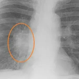 Затемнение в лёгких: что это такое и когда стоит беспокоиться?