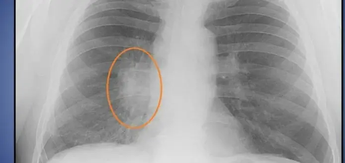 Затемнение в лёгких: что это такое и когда стоит беспокоиться?