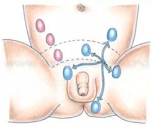 Крипторхизм у взрослых мужчин и его последствия: бесплодие, варикоцеле и эктопия яичка