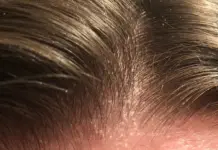 Себорейный дерматит и биоревитализация: как восстановить кожу и вернуть комфорт