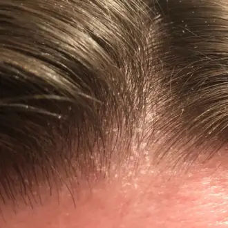 Себорейный дерматит и биоревитализация: как восстановить кожу и вернуть комфорт