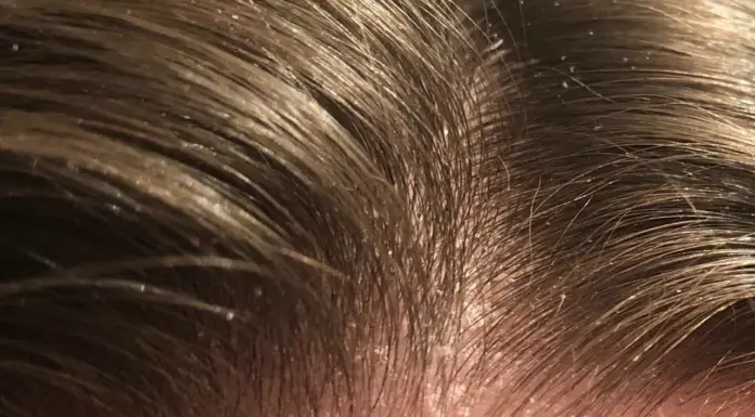 Себорейный дерматит и биоревитализация: как восстановить кожу и вернуть комфорт