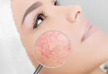 Удаление сосудов на носу: методы, эффективность и последствия