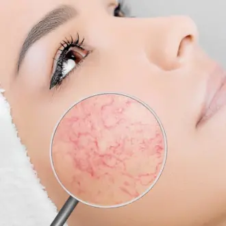 Удаление сосудов на носу: методы, эффективность и последствия