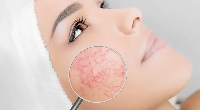 Удаление сосудов на носу: методы, эффективность и последствия