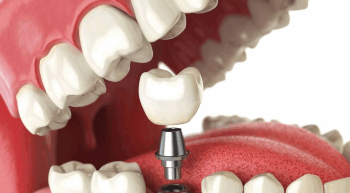 Имплантация зубов: полное руководство по методам, этапам и стоимости