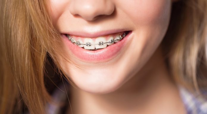 Установка систем брекетов от компании «Мои родные» в Астрахани