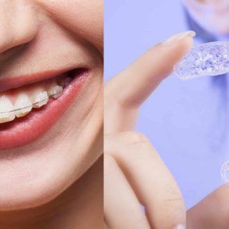 Выравнивание зубов элайнерами: процесс и особенности