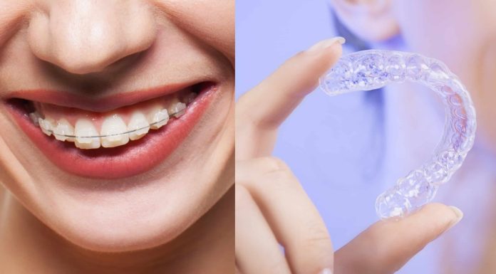 Выравнивание зубов элайнерами: процесс и особенности