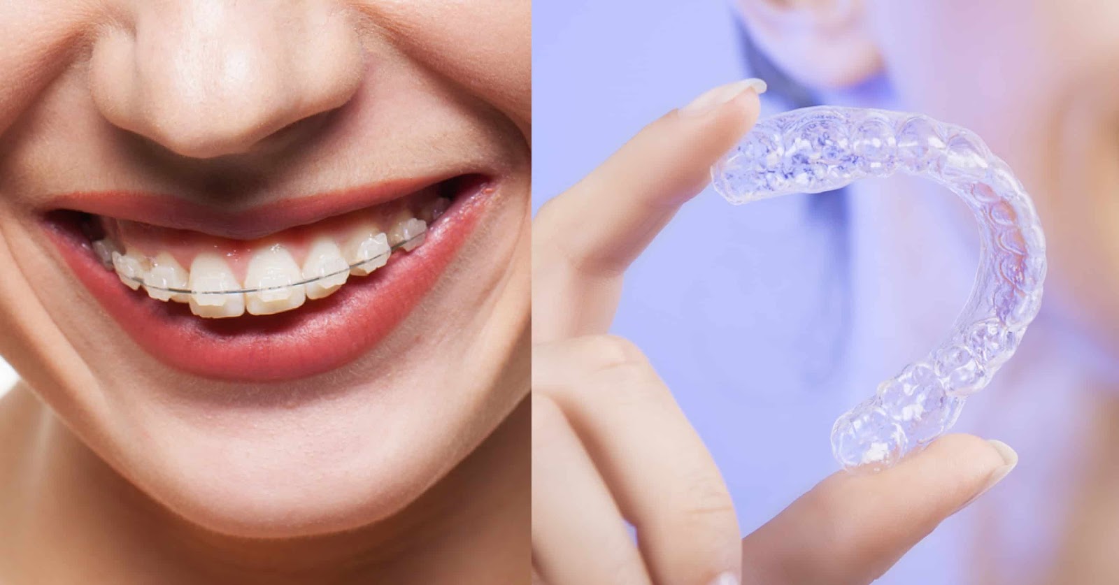 Выравнивание зубов элайнерами: процесс и особенности