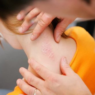 Лечение и диагностика псориаза
