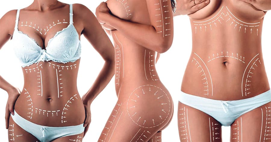 Эстетическая коррекция тела — липомоделирование